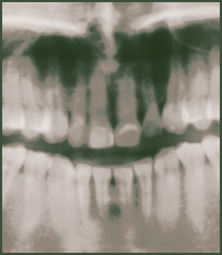 Root Canals Root Canals